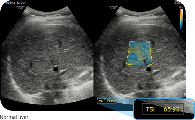 TSI™ : Normal liver ultra sound image