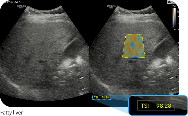 TSI™ : fatty liver ultrasound image