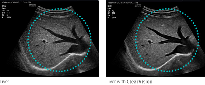 Liver with ClearVision