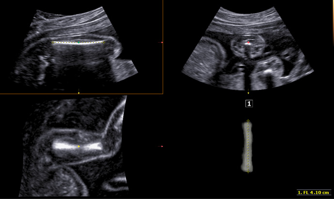5D LB™(Fetal long bone detection) Sample