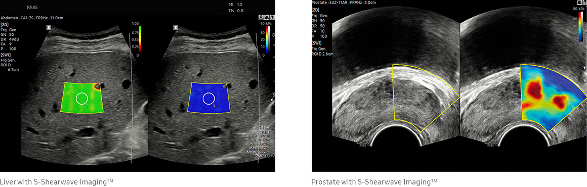 Liver with S-Shearwave Imaging™, Prostate with S-Shearwave Imaging™
