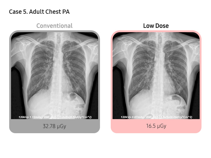 Case 5. Adult Chest PA