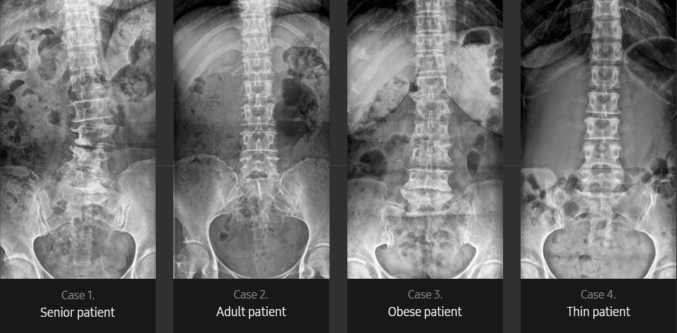 Lumbar Spine AP Sample
