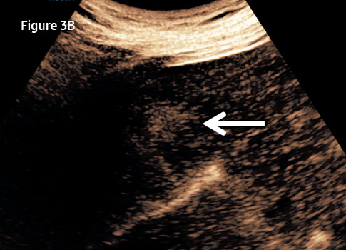 Figure 3A. On the B-mode sonographic examination, a well-circumscribed ...