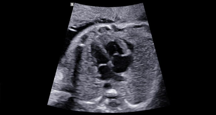 2d images : Fetal heart 4ch view