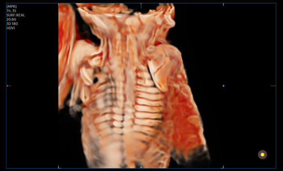 3d imaging : Fetal spine with CrystalVue™