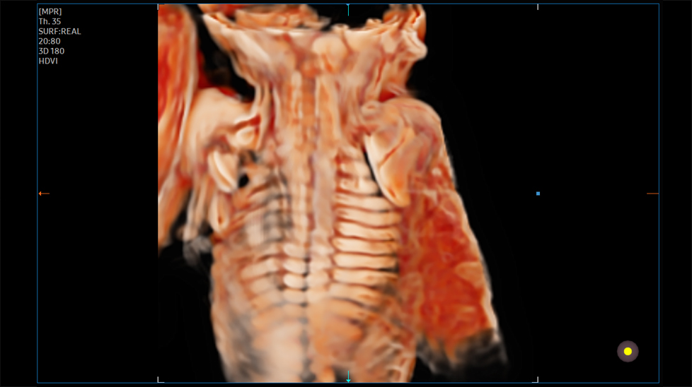 3d imaging : Fetal spine with CrystalVue™