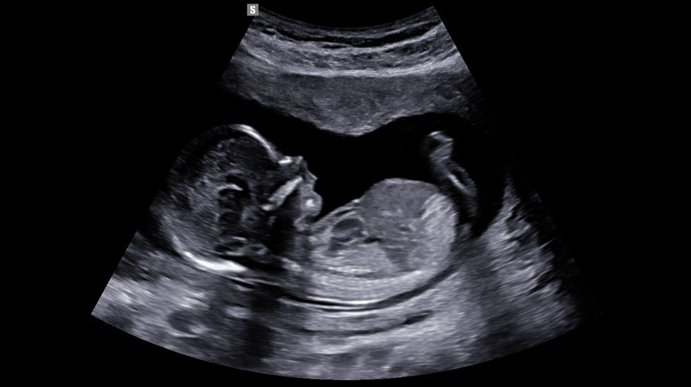2d images : 1st trimester fetal profile view