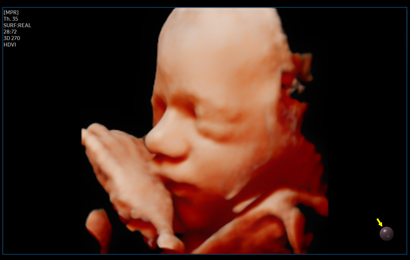 3d imaging : Fetal face with RealisticVue™