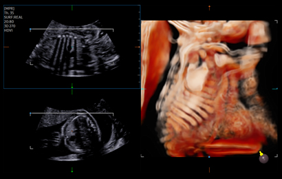 3d imaging : Fetal ribs and scapula with CrystalVue™