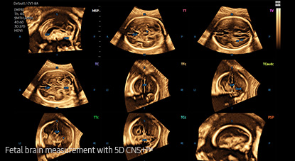 5d ultrasound : 5D CNS+™