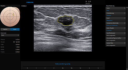ultrasound for breast : S-Detect™ ¹,³ for Breast 