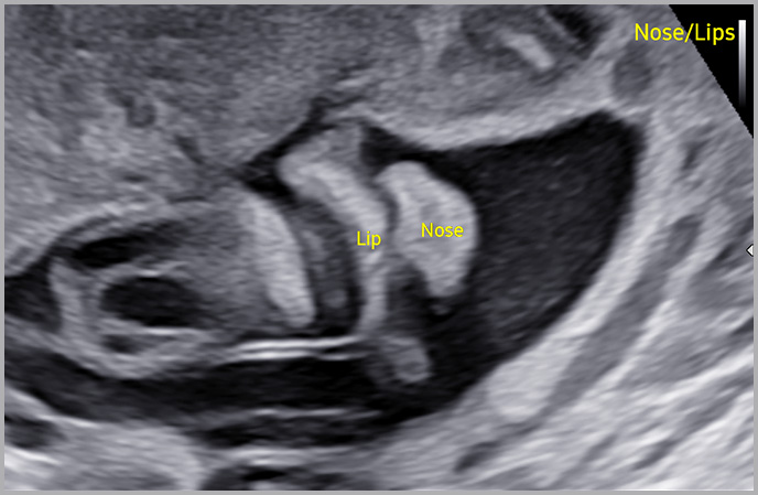 Fetal ultrasound : Fetal nose