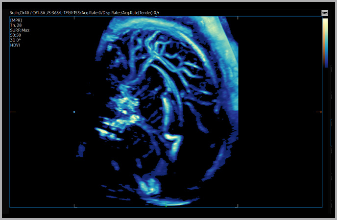 imaging solutions : Fetal brain with MV-Flow™ ¹