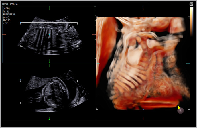 3d imaging : Fetal ribs and scapula with CrystalVue™ ¹