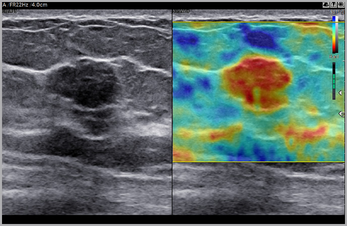 breast assessment : Breast with ElastoScan+™ ¹, ²