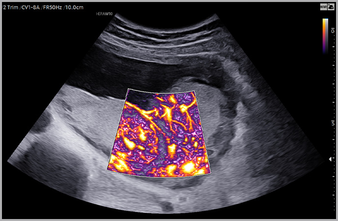 imaging solutions : Placental perfusion (MV-Flow™ ¹ with LumiFlow™)