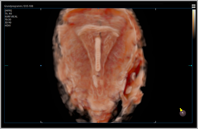 3d imaging : Intra uterine device with CrystalVue™ ¹