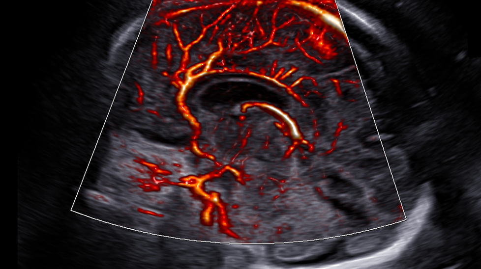imaging solutions of ob ultrasound : MV-Flow™ with LumiFlow™