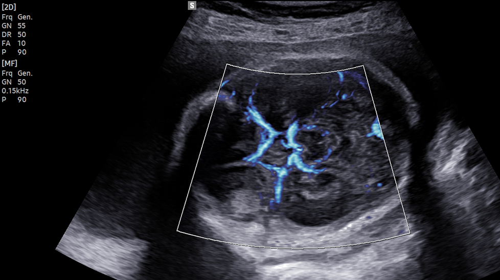 powerful imaging of ultrasound ob : BPD with MV-Flow™ 