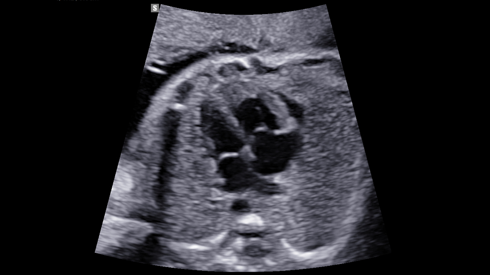 fetal images : Fetal Heart 4ch view