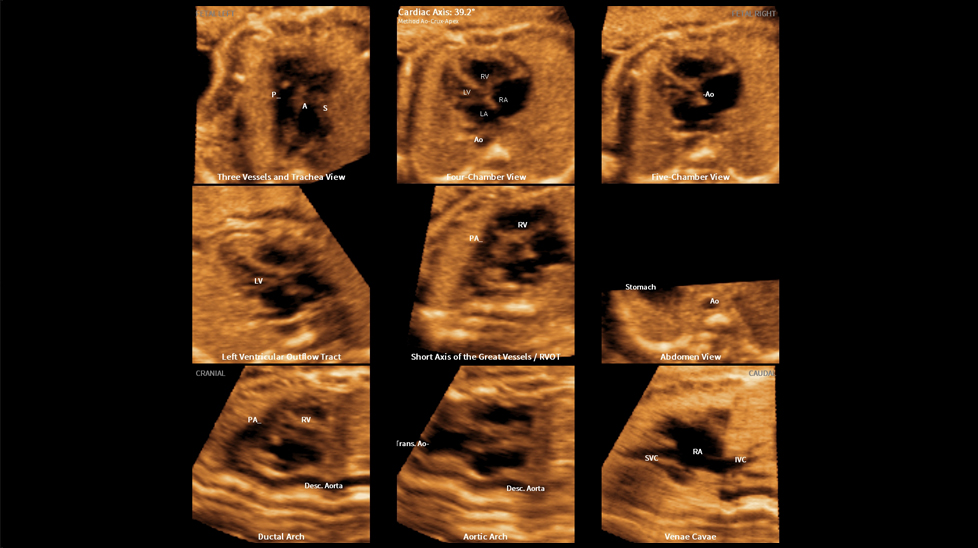 ultrasound in obstetrics tech : 9 fetal heart standard views with 5D Heart Color™