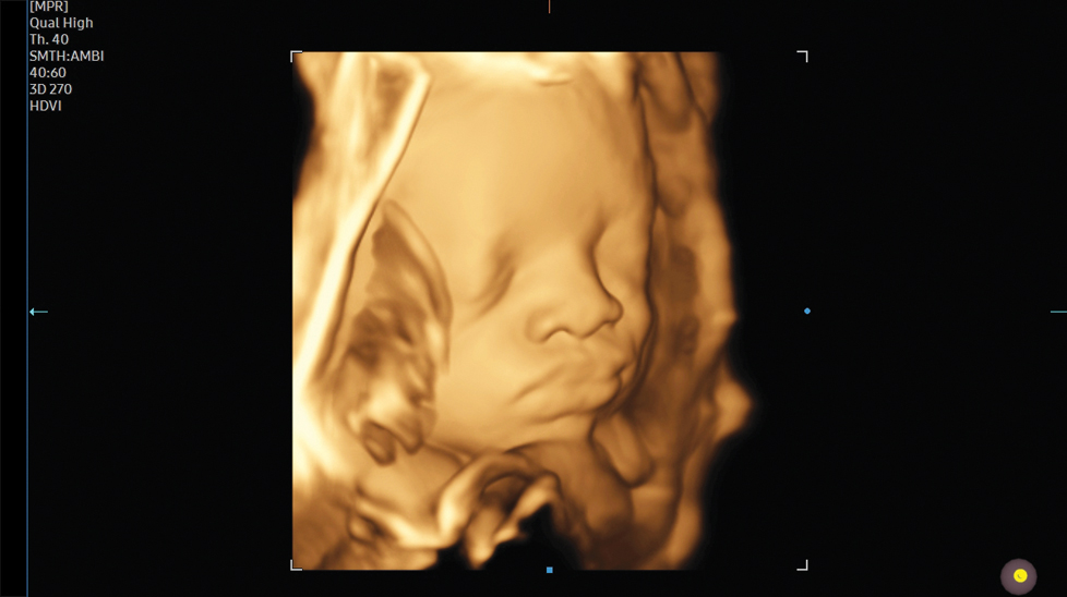 fetal images : Fetal face with HDVI™