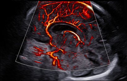 imaging solutions of ob ultrasound : MV-Flow™ with LumiFlow™