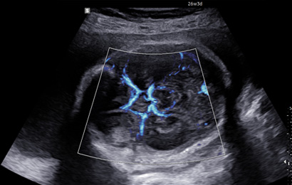 powerful imaging of ultrasound ob : BPD with MV-Flow™ 