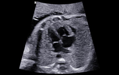 fetal images : Fetal Heart 4ch view