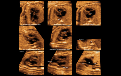 ultrasound in obstetrics tech : 9 fetal heart standard views with 5D Heart Color™
