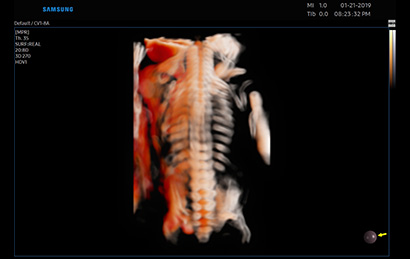3d imaging of ultrasound imaging machines : Fetal Spine with CrystalVue™