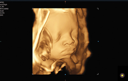 fetal images : Fetal face with HDVI™