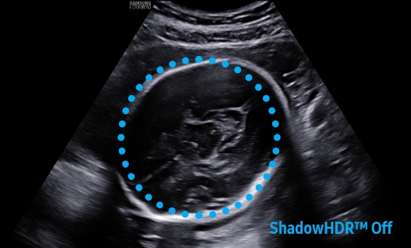 imaging solutions of ob ultrasound : ShadowHDR™ - off