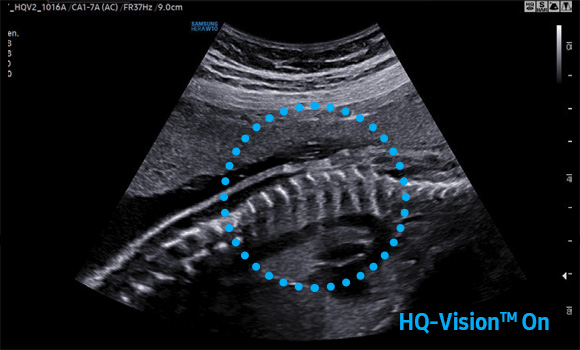 imaging solutions of ob/gyn ultrasound : HQ-Vision™ - on