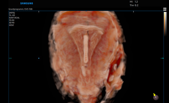 3d imaging of ultrasound ob gyn : CrystalVue™ 
