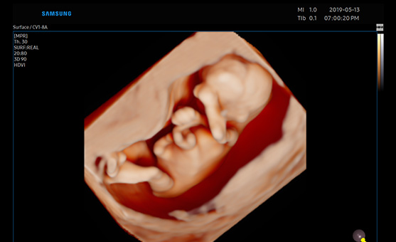 3d imaging of ultrasound ob/gyn : RealisticVue™ 