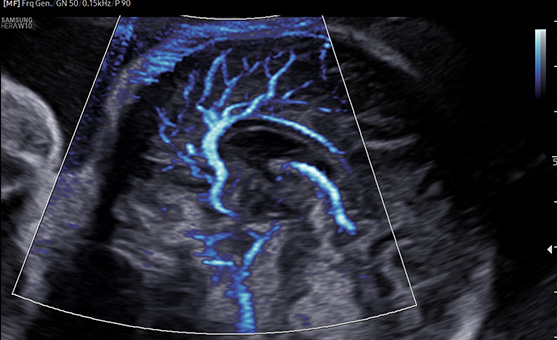 Color imaging of ultrasound devices : MV-Flow™