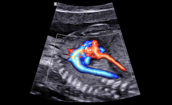 Color imaging of ob/gyn ultrasound machine : S-Flow™