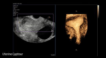 gyn ultrasound tech : Uterine Contour