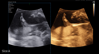 medical diagnostics of ultrasound ob : Slice A