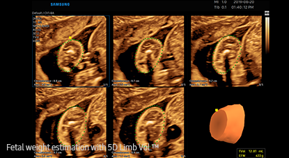 5d ultrasound : 5D Limb Vol.™