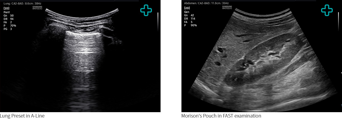 Lung Preset in A-Line, Morison's Pouch in FAST examination