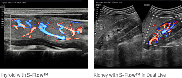 Kidney with S-Flow™ in Dual Live