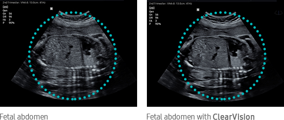 Fetal abdomen, Fetal abdomen with ClearVision