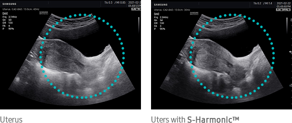 Uterus, Uters with S-Harmonic™