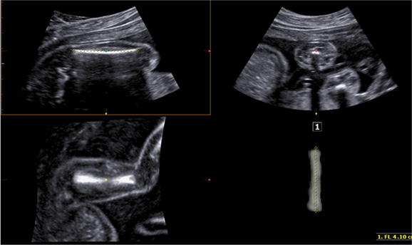 5D LB™(Fetal long bone detection) Sample