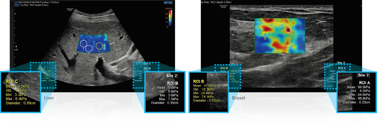 fatty liver ultrasound (liver stiffness assessment) : S-Shearwave Imaging™, ultrasound for breast (breast stiffness assessment) : S-Shearwave Imaging™