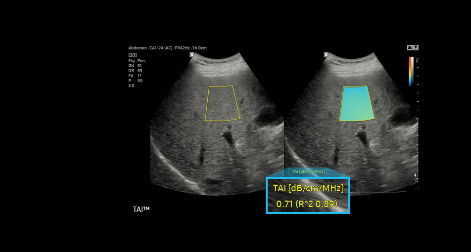 new ultrasound technology TAI™ ¹