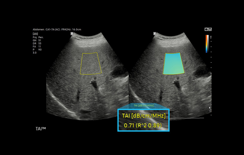 new ultrasound technology TAI™ ¹